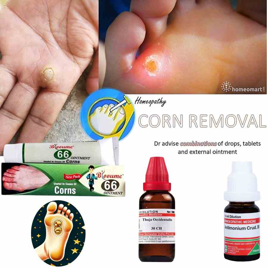 Homeopathic treatment for corns on feet online