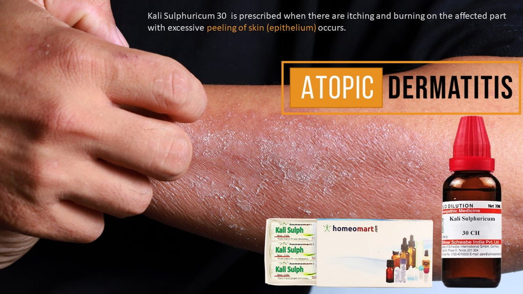 eczema with skin peeling Exfoliative dermatitis treatment in homeopathy