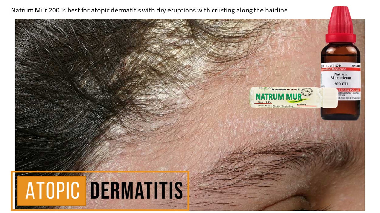 atopic dermatitis (eczema) of scalp scalp treatment in homeopathy