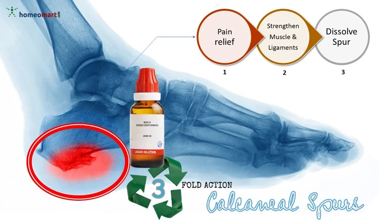 Bottle of a product for calcaneal spurs with an X-ray of a foot showing pain relief and muscle strengthening effects.