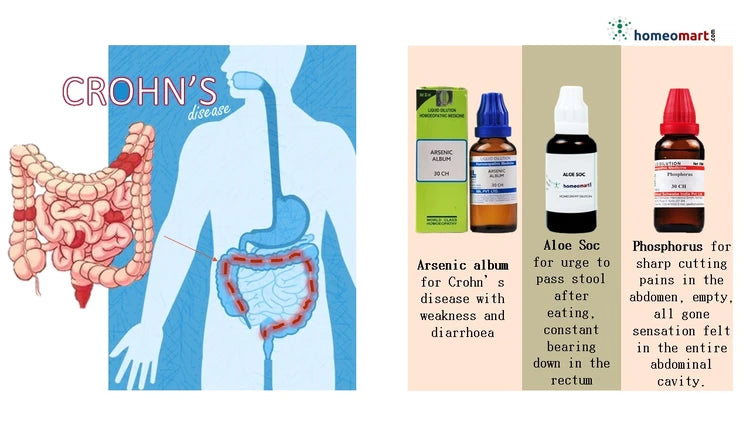 Illustration of Crohn's disease with homeopathic medicine indications with bbottles on a white background
