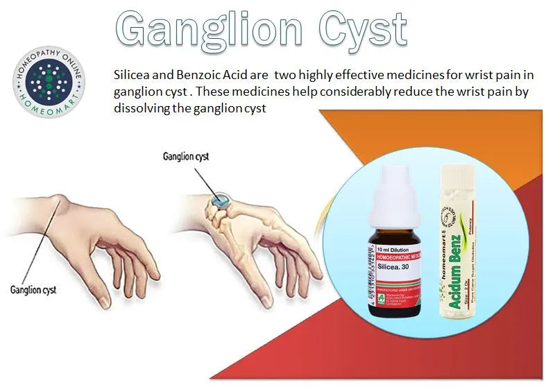 Illustration of ganglion cyst on wrist with medicines for treatment