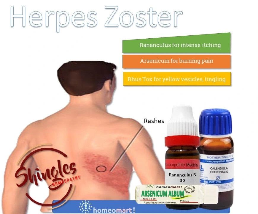 image of a man with herpes zoster and medicines bottles of ranunculus and calendula off