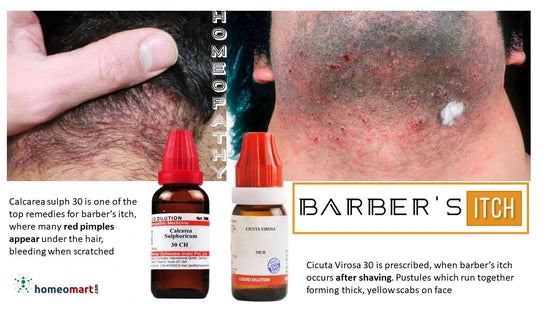 expert identified key homeopathic remedies for treating barber’s itch, beard folliculitis, and skin infections naturally and effectively.