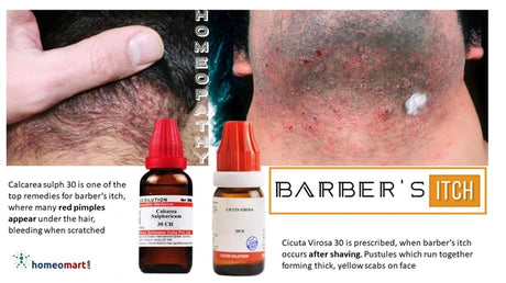 expert identified key homeopathic remedies for treating barber’s itch, beard folliculitis, and skin infections naturally and effectively.