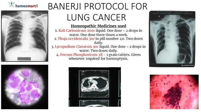 Banerji Protocol offers a systematic homeopathic approach to lung cancer symptoms like haemoptysis and breathlessness, using key remedies such as Kali Carbonicum 200c and Thuja Occidentalis 30c for holistic respiratory and tumor support