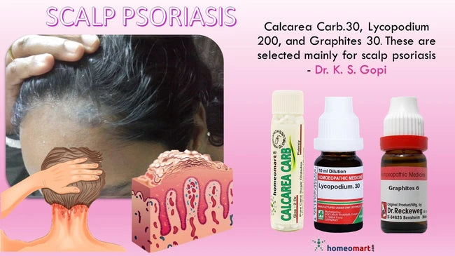 If you have scalp psoriasis, a combination of these natural remedies may be provide relief