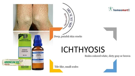 Soothe, Heal & Restore Scaly Skin – The Homeopathic Way!  op Homeopathic Remedies for Ichthyosis (Fish Scale Disease)