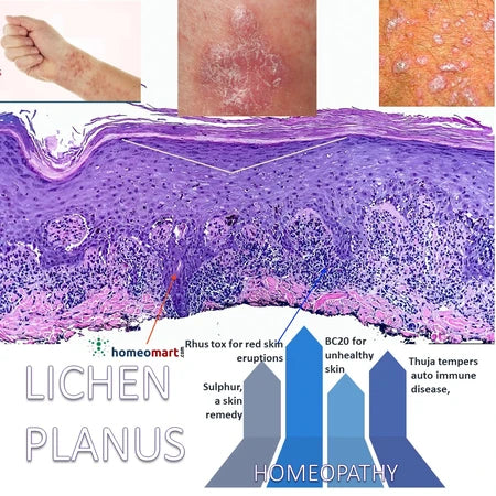 Say goodbye to chronic itching, rashes & oral sores! Safe & natural lichen planus homeopathy kits for complete skin and mucous membrane care.