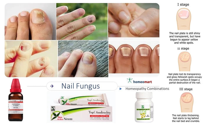 Collage of nail conditions and homeopathic remedies for nail fungus, with text on stages of nail fungus.