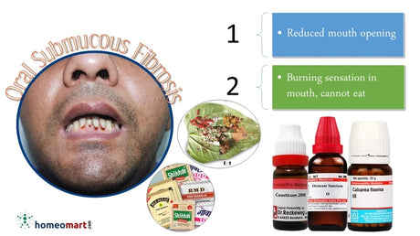 best natural remedies for OSMF Oral Submucous Fibrosis (OSMF treatment ), Mouth Stiffness