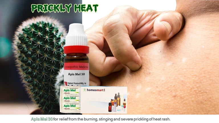 Homeopathy Apis Mellifica 30 – Cooling relief for heat rash