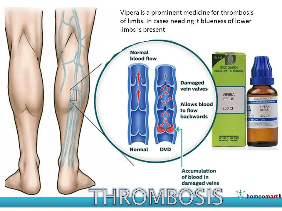 Diagram of thrombosis in limbs with a bottle and box labeled 'Vipera Berus' on a white background.