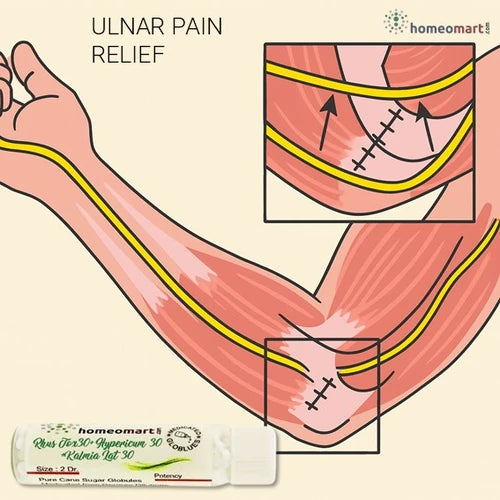 ulnar nerve compression or irritation, can lead to a range of symptoms including numbness, tingling, and pain in the little finger and part of the ring finger, often extending into the hand and even up the arm.