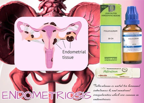 Folliculinum 30 – Balances hormonal fluctuations, easing premenstrual tension and cycle irregularities in endometriosis