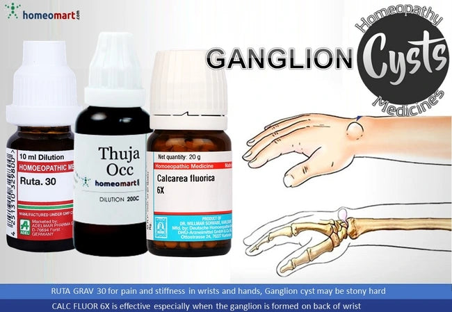 Three homeopathic medicine bottles with labels and an illustration of a hand with ganglion cysts.