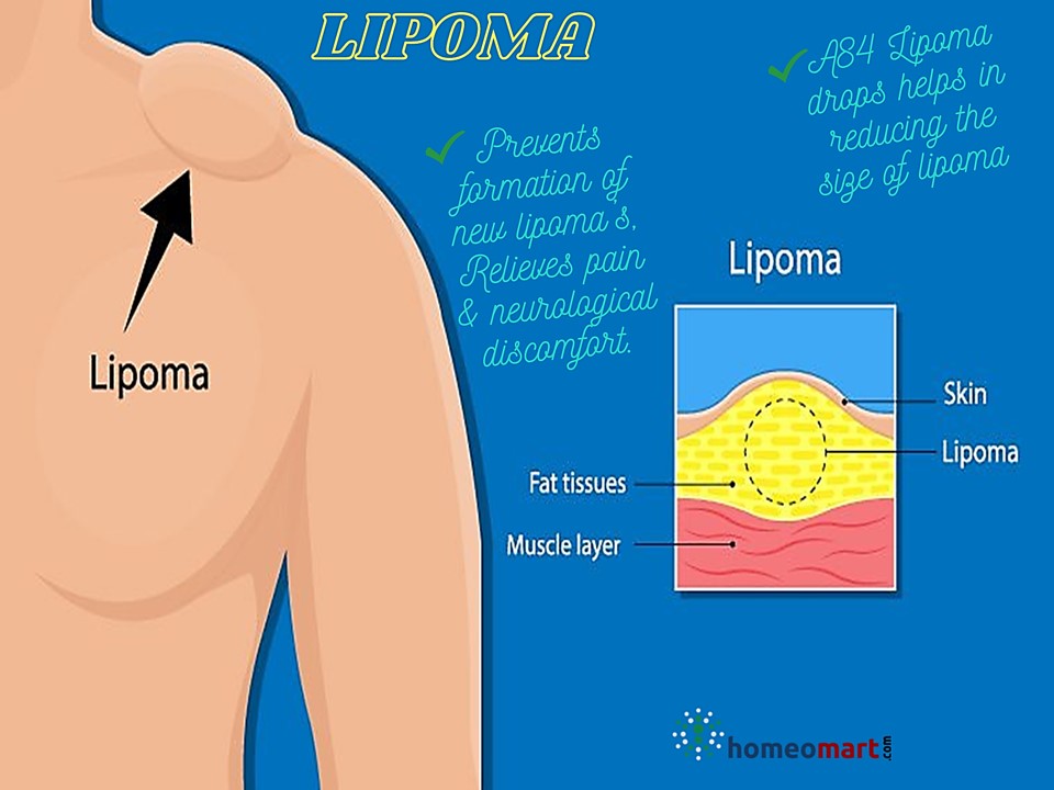 Remove Fatty Tumor, Skin Lumps naturally with homeopathy