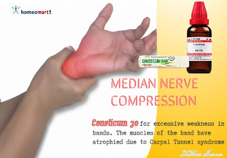 arnica 30 for carpal tunnel syndrome due to typing or repetitive injury