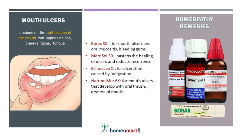 Informational graphic about mouth ulcers and homeopathy remedies with illustrations and text.