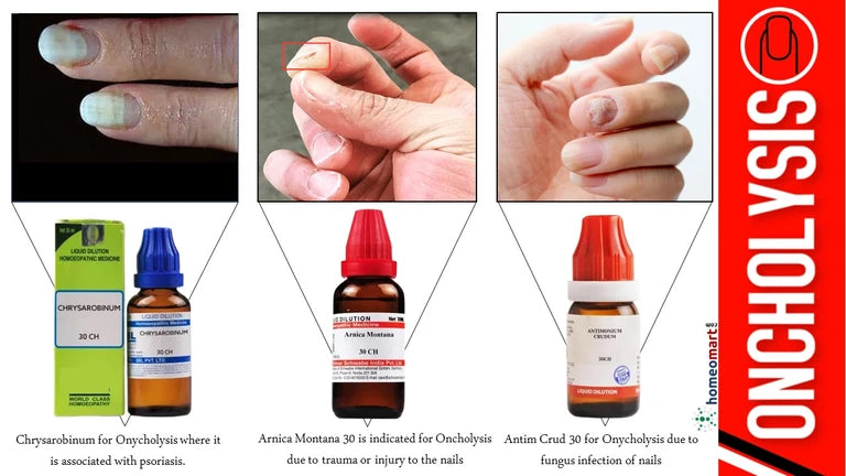 Onycholysis treatment at home with our doctor curated homeopathy remedies