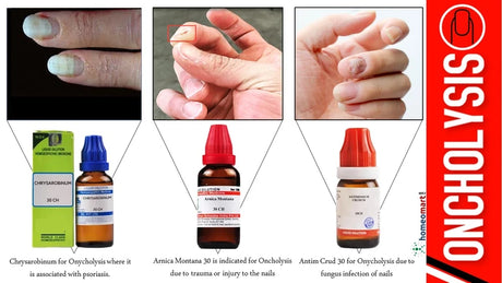 Onycholysis treatment at home with our doctor curated homeopathy remedies
