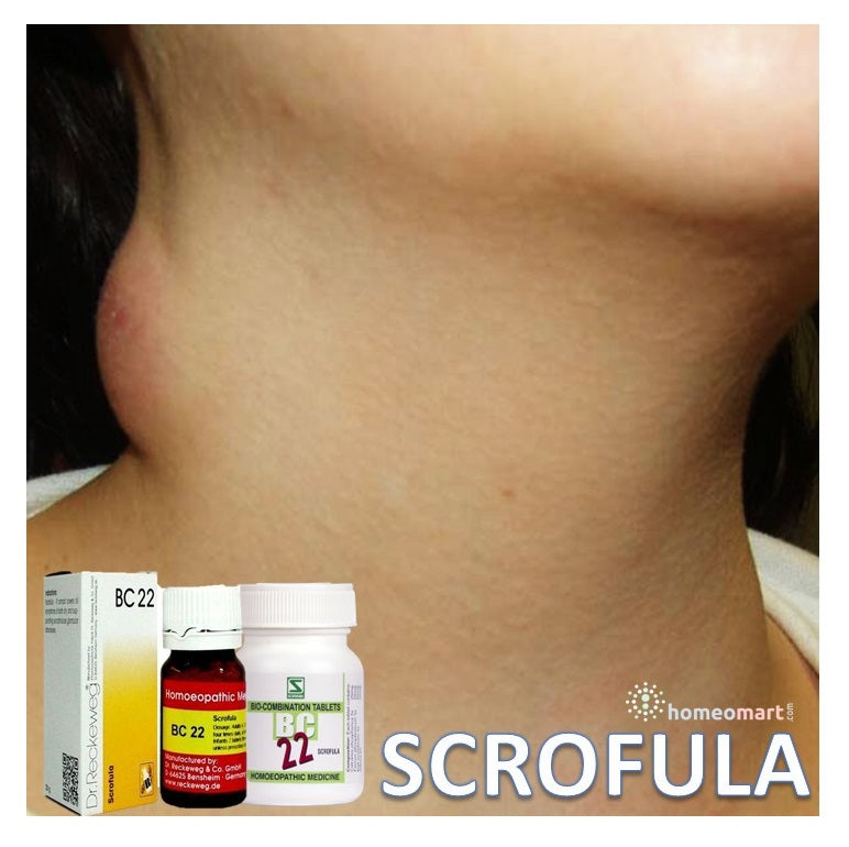 scrofula treatment BC22 tablets cervical tuberculous lymphadenitis Mycobacterium tuberculosis , remedy for swollen lymph nodes in neck and chronic gland infection, treatment for scrofuloderma skin nodules and ulceration homeopathy, medicine for suppurating abscess and pus formation natural, relief for chronic skin infections and glandular enlargement homeopathyinfection