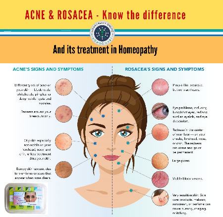acne and rosacea difference infographic