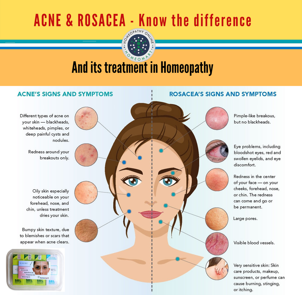 acne and rosacea difference 