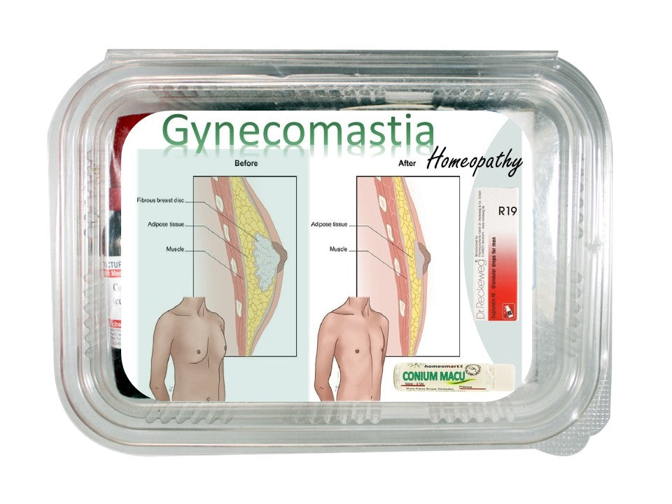 Gynecomastia treatment without surgery homeopathy medicine