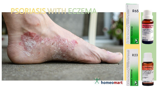 homeopathy treatment for psoriasis with eczema with Reckeweg R65 and R23 drops