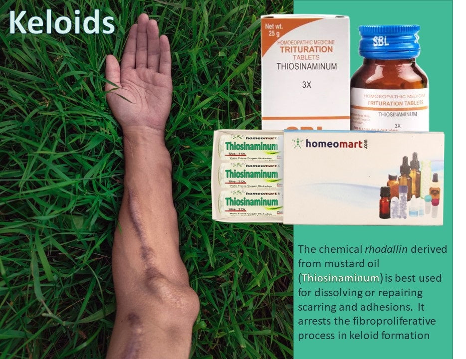 keloid scar treatment in homeopathy