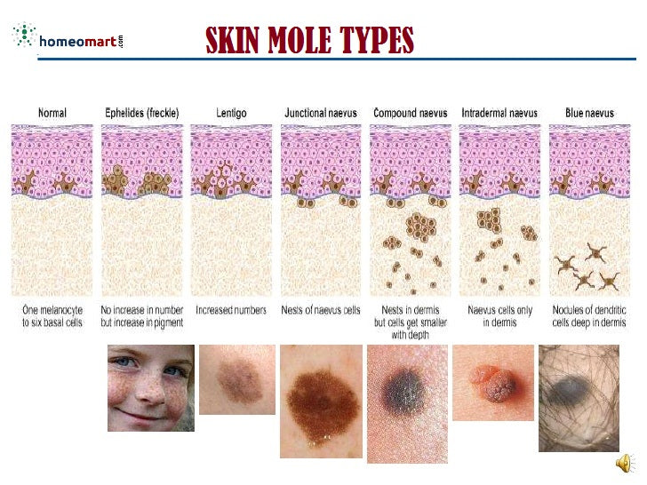 skin mole types infographic