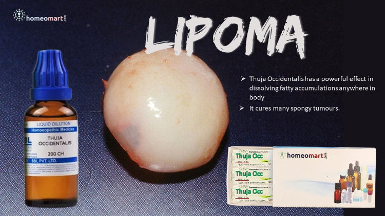 Thuja Occidentalis benefits in lipoma removal in homeopathy