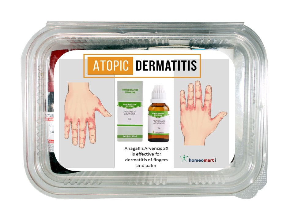 Atopic dermatitis treatment homeopathy medicines