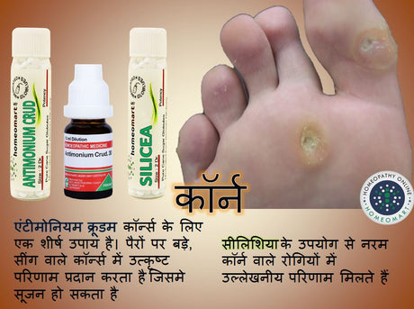 foot corns treatment in hindi