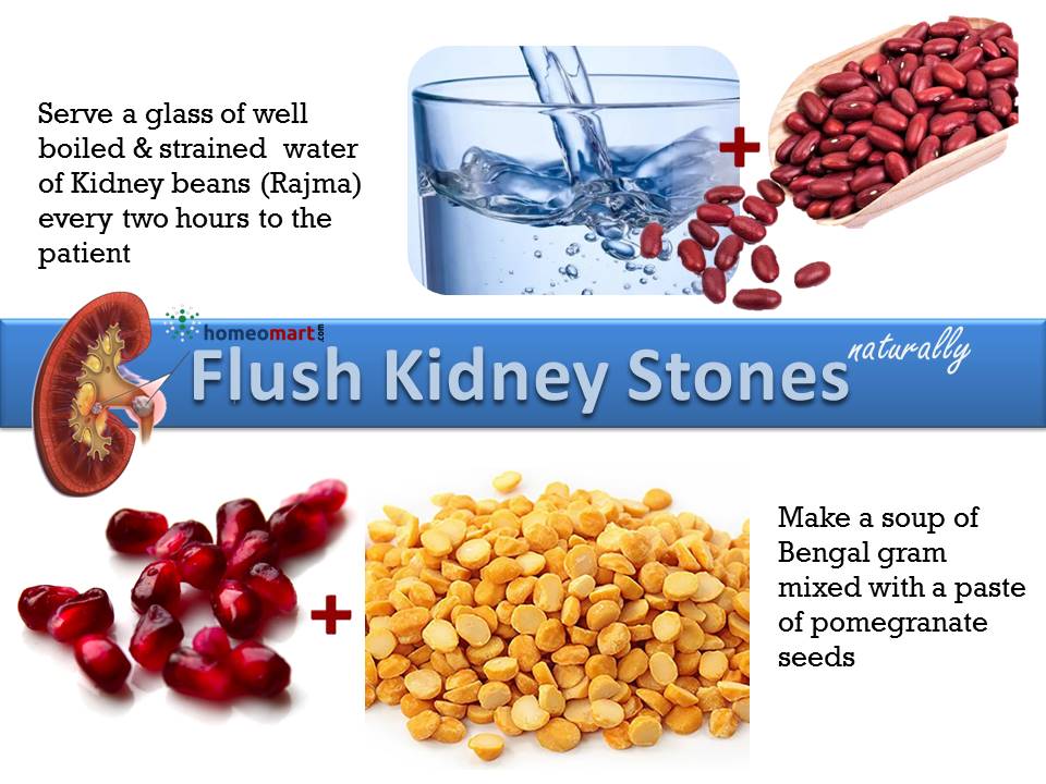 Natural and Homeopathic Remedies for Kidney Stones Treatment