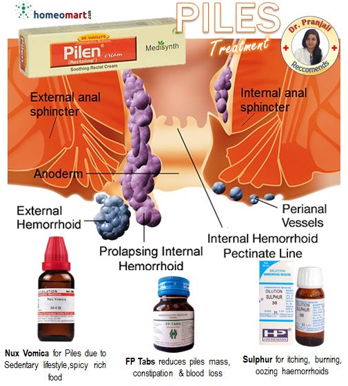 Homeopathy piles medicines - Tailored Remedies for Specific Pile Symptoms and Conditions