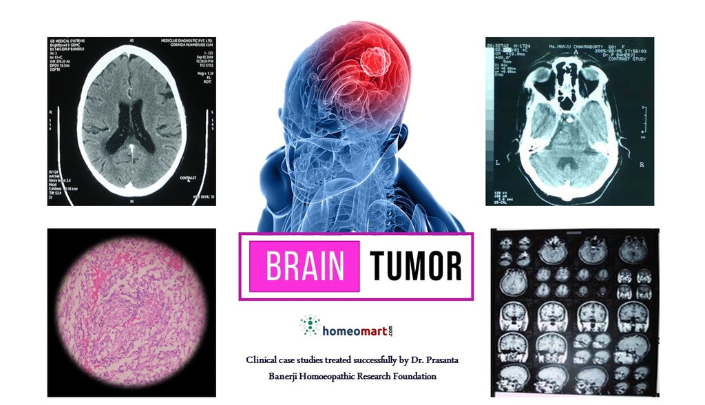 Brain tumor success stories in homeopathy with symptoms, medicines ...