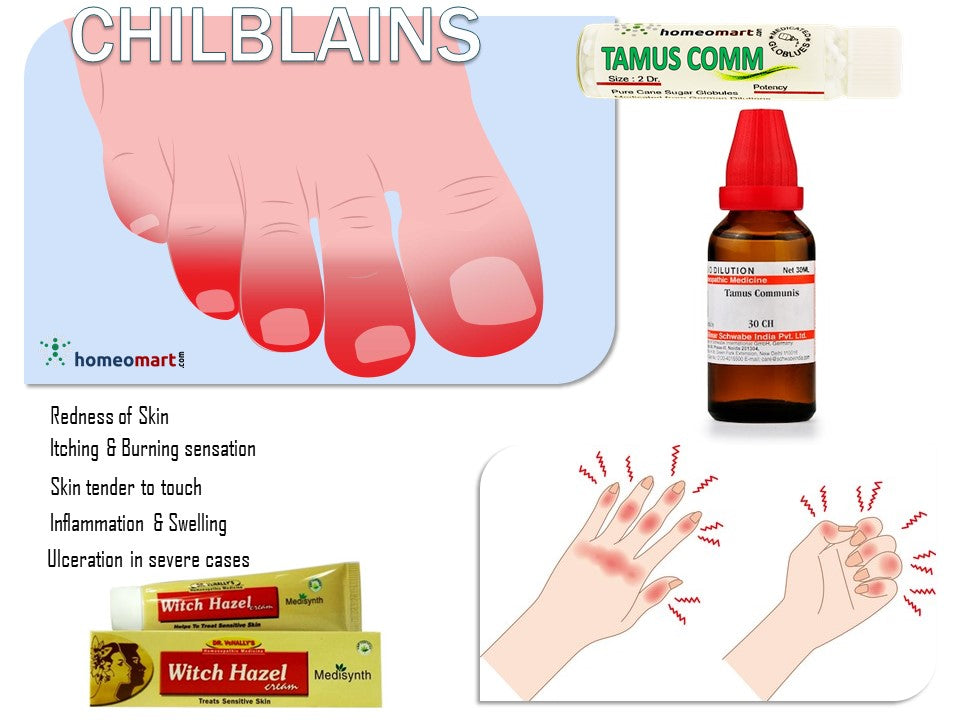 Chilblains Homeopathy Remedies