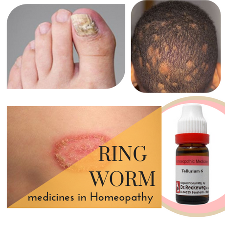 Homeopathy Ringworm Treatment Medicines