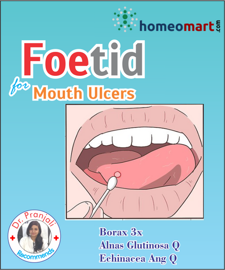 Mouth Ulcer treatment in Homeopathy 