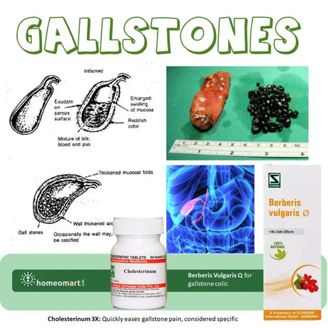 Natural Gallbladder Stone Treatment with homeopathy medicines