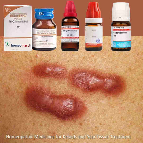 Homeopathic Medicines for Keloids and Scar Tissue Treatment