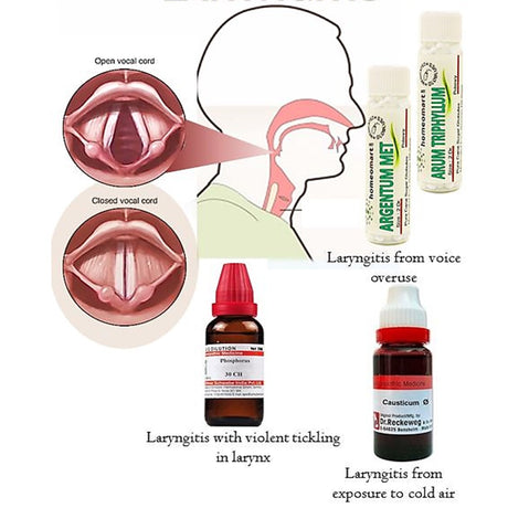 Homeopathic Remedies for Laryngitis