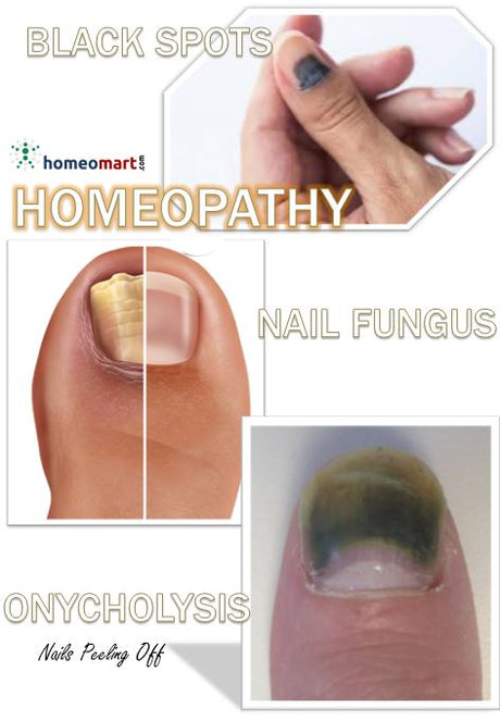 Homeopathy for nail infection, damage