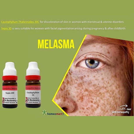 Melasma treatment homeopathic medicines