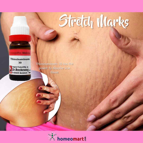 Restore Your Skin's Beauty: Homeopathic Treatments for Stretch Marks