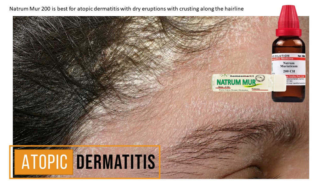atopic dermatitis (eczema) of scalp scalp treatment in homeopathy 