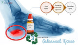 Bottle of a product for calcaneal spurs with an X-ray of a foot showing pain relief and muscle strengthening effects.