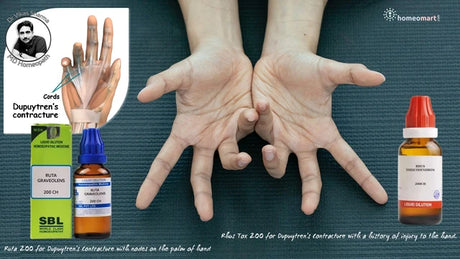 Hands withDupuytren's contracture, bottles of homeopathic remedies, and promotional text on a blue background.